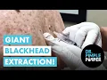Lagu Dilated Pore of Winer Giant blackhead!
