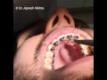 Download Lagu Lingual Braces, Teeth Clip, Invisible Braces