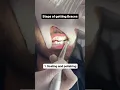 Download Lagu 3 Steps of Getting Braces | Braces Procedure in Lahore | Orthodontic Treatment | Dental Aesthetics