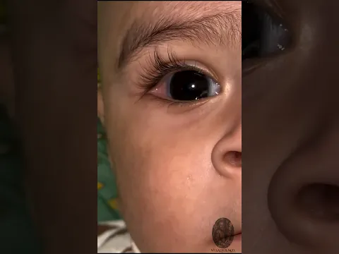 Esclerótica azul