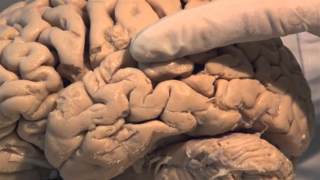 Neuroanatomy Brain Dissections: Lobes, Gyri & Localization