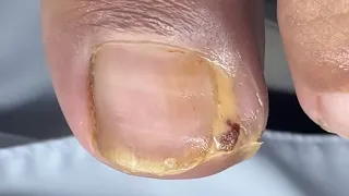 O Uber com unha encravada crônica #nails #satisfying