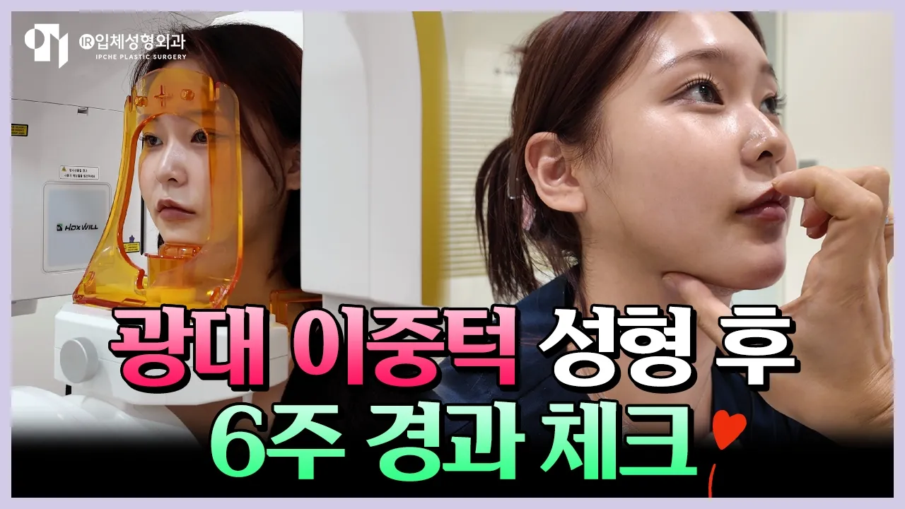 성형외과 직원의 성형 브이로그 2탄✨ 광대축소+이중턱 근육묶기 6주 경과 공개!｜비포애프터⭕｜입체성형외과