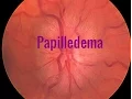 Papilledema A Swollen optic disc