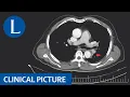 Diagnosing a mediastinal mass