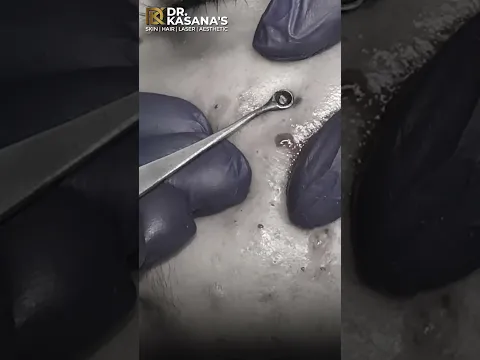 Blackheads Removal By Dr. Lalit #blackheads