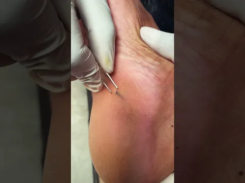 Thorn Removal #removal