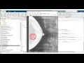 Deep learning in Breast Cancer mammography images segmentation classification Improve Detection