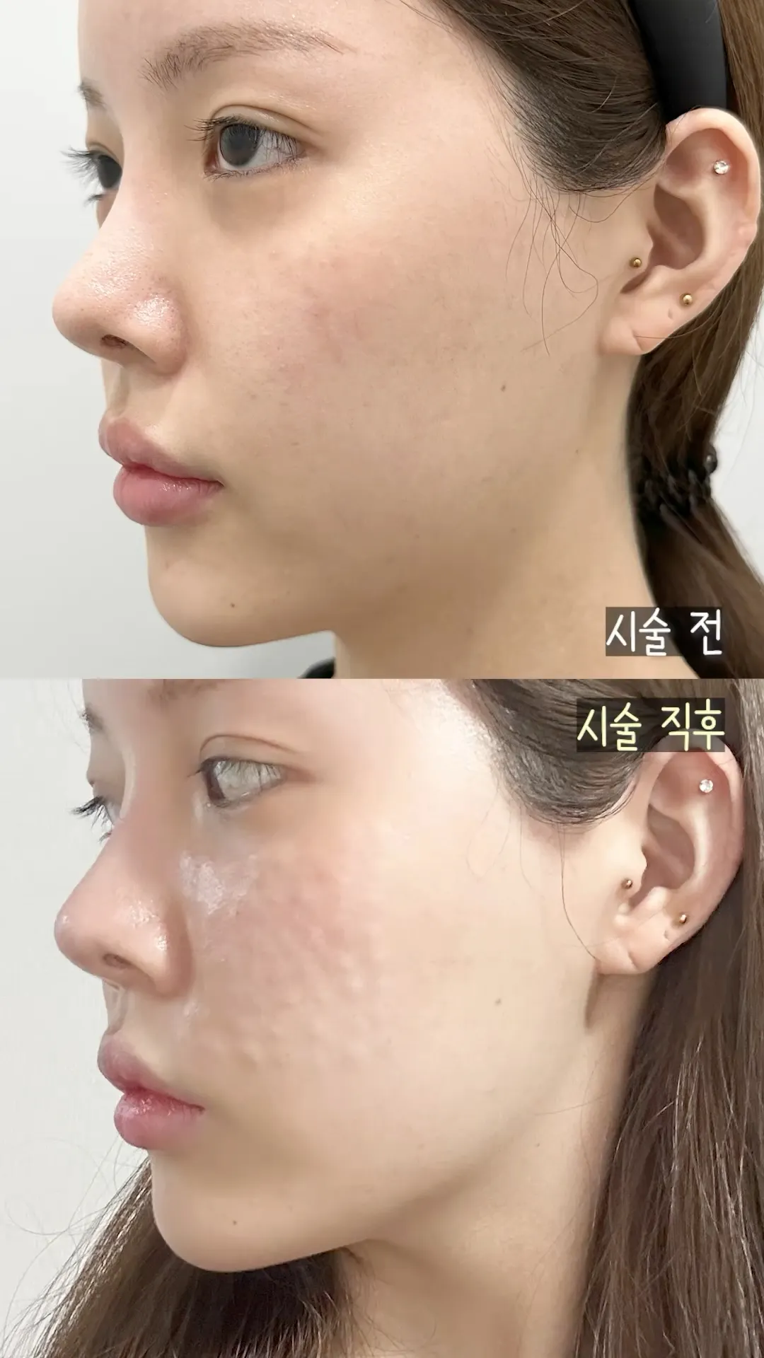 10초 만에 리쥬란 효과 체험하기👀