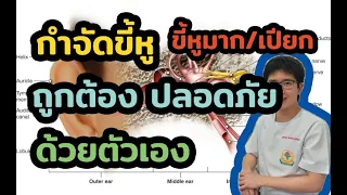 วิธีรักษาขี้หูอุดตันที่บ้านมีขั้นตอนอย่างไรบ้าง และควรใช้ยาอะไร