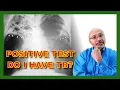 Tuberculosis What The Positive Test Means