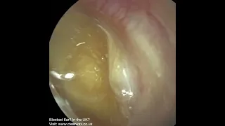 1,733 - Dead Skin Carefully Peeled from a Previously Perforated Eardrum | WAXscope®