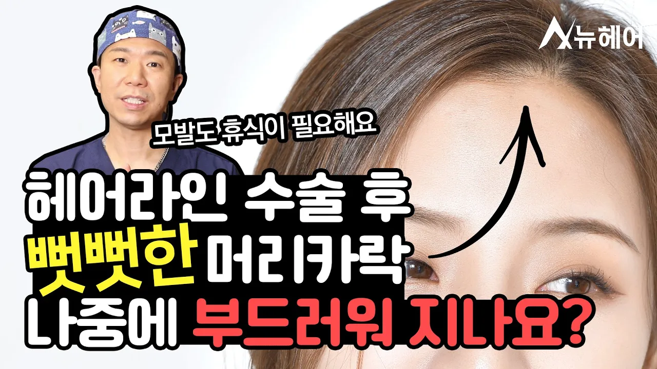 헤어라인 수술 후 뻣뻣한 머리, 나중에 부드러워 지나요?｜뉴헤어