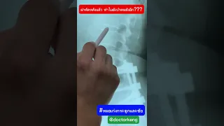  ทำไมคนที่เคยผ่าตัดกระดูกสันหลังแล้วถึงมีอาการเจ็บร้าวลงขา 