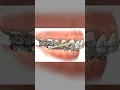 Class II elastics in Orthodontics