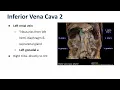 Inferior Vena Cava Tributaries