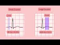ECG Tip QRS Duration Grid Interpretation