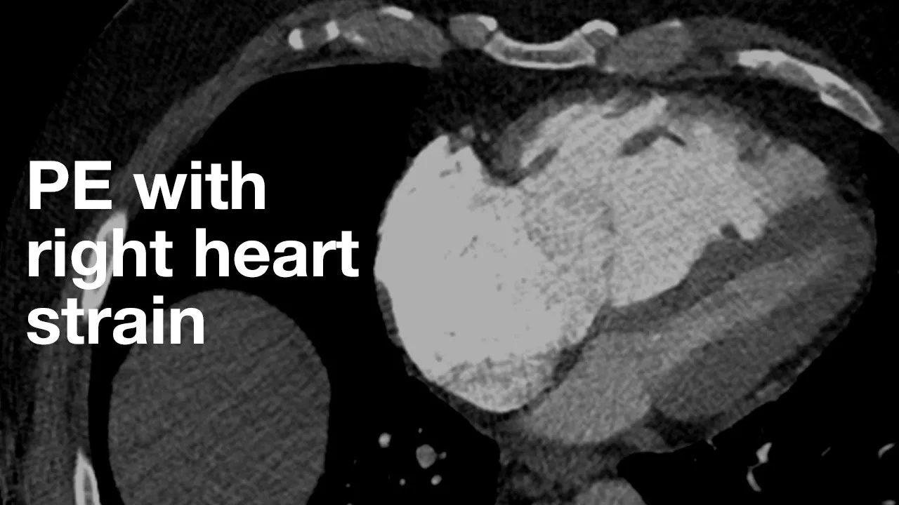 CT signs of right heart strain with PE