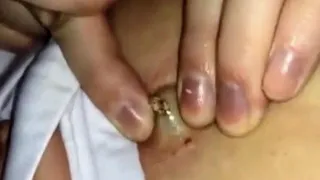 إزالة أكبر الرؤوس السوداء في العالم ليس لأصحاب القلوب الضعيفة 