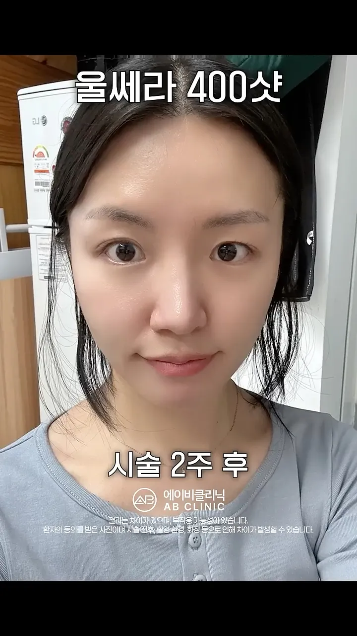 울쎄라 400샷 효과