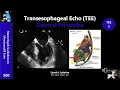 Transesophageal Echo TEE 1 - General Principles