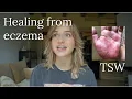 My healing story - Dealing with eczema, TSW