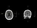 Unremarkable Non-Contrast Head CT Coronal Scan - Example 1