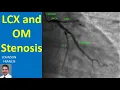 LCX and OM Stenosis