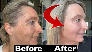 Laser Skin Resurfacing After 50: Can We Really Start Over?
