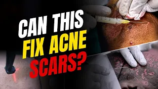 Deep Acne Scar Treatment with Subcision + CO2 Laser! | LIVE Procedure | Clear Skin Clinic, Pune