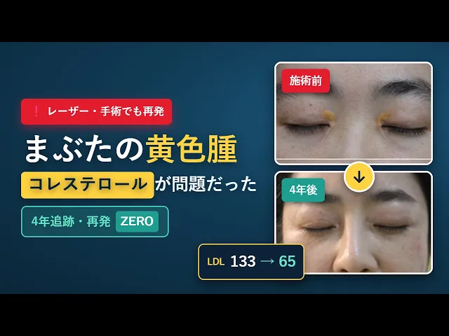 まぶたの黄色腫、取っても再発する理由|原因はコレステロールだった(4年経過)#眼瞼黄色腫 #黄色腫 #まぶたの黄色腫 #xanthelasma #コレステロール #LDLコレステロール