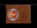 Optic Disc Apperance