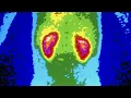 A Man Took 1176 Ibuprofen Tablets In A Month This Is What Happened To His Kidneys