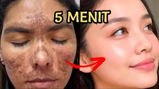 HABISI TUNTAS FLEK HITAM DI PIPIMU SAMPAI AKARNYA!!