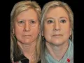 Segmental Brow Lift - a SOOF Lift Blepharoplasty Co2 Laser Resurfacing of eyes and mouth