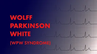 Wolff Parkinson White WPW Syndrome EKG ECG Interpretation 