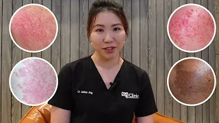 Dual Yellow Laser by MyClinic