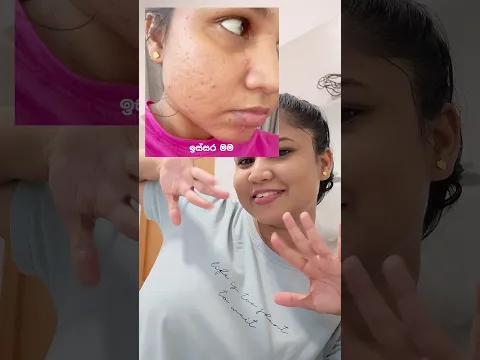 ඔයත් pimples වලට bye කියන්න 😉 #skincare #pimples #janet #trending