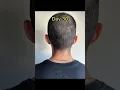 Donor area after a