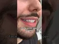 Download Lagu #veneers nieuw facings beste kwaliteit