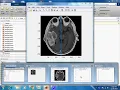 Brain tumor detection in matlab