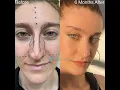 Download Lagu Female Rhinoplasty | Natural Change