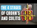 Lagu De 4 stadia van de ziekte van Crohn en colitis ulcerosa (IBD)