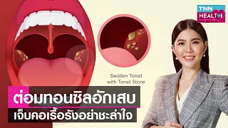 ควรหลีกเลี่ยงอาหารอะไรเมื่อเป็นต่อมทอนซินอักเสบ