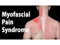 Lagu Behandelingen voor myofasciaal pijnsyndroom en triggerpoints, animatie.