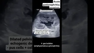 Acute pyelonephritis pyonephrosis on ultrasound