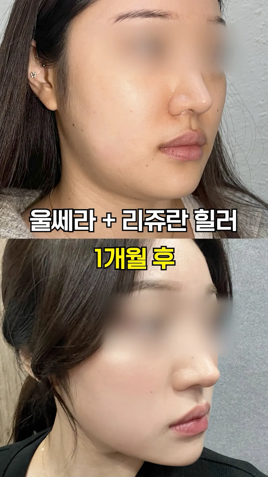 겨울철 필수 시술 조합 💯