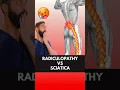 The Truth About Radiculopathy VS Sciatica Revealed