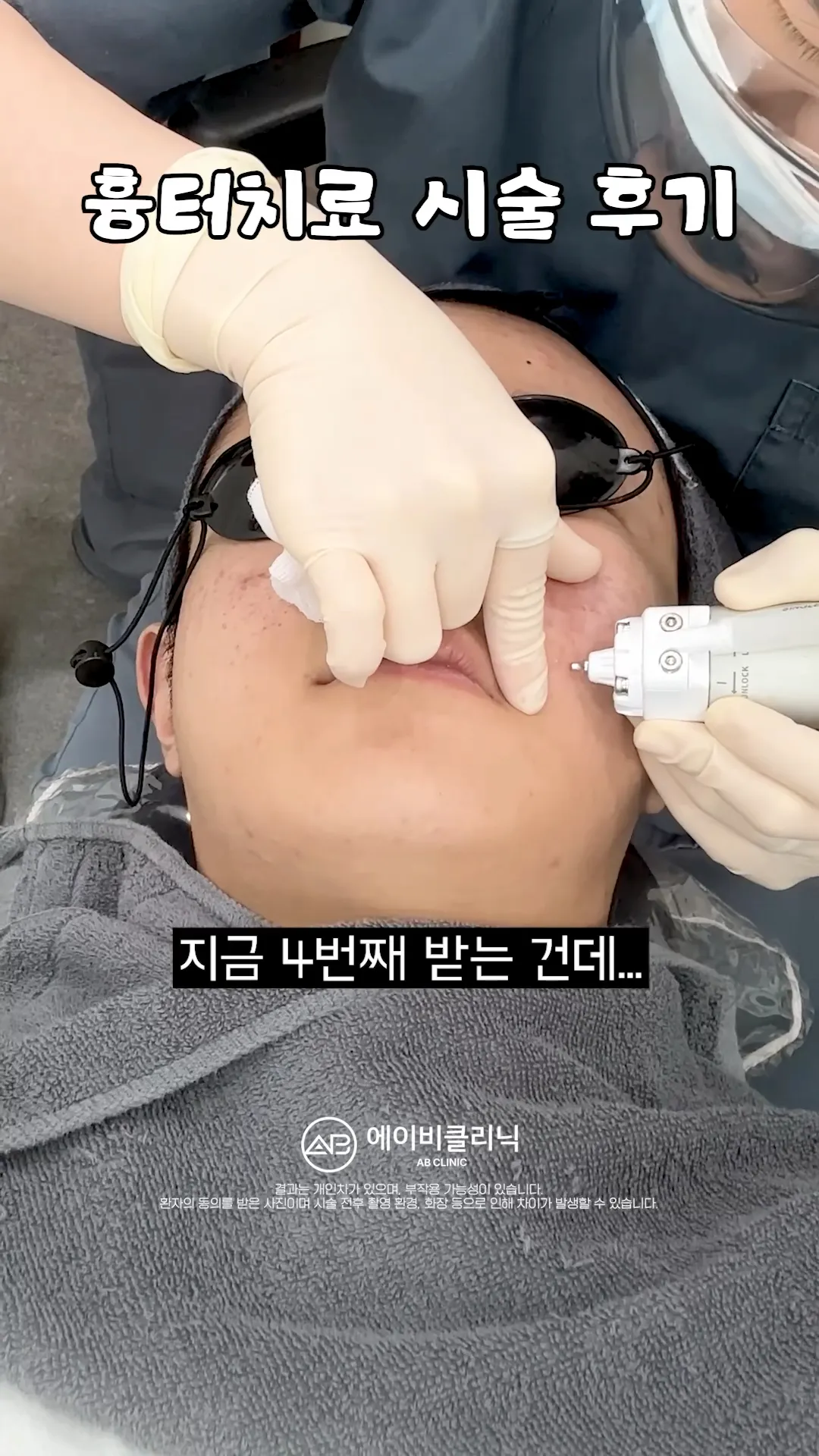 여드름 흉터치료 브이로그❗