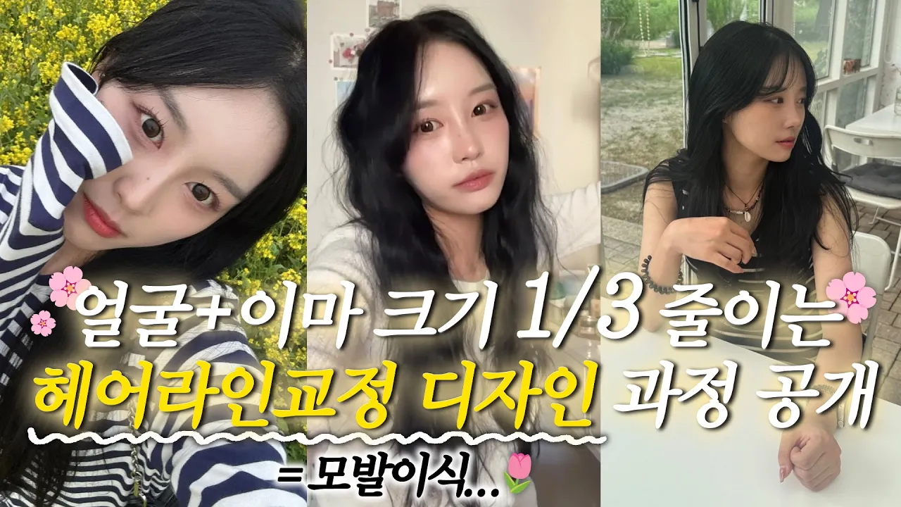 넓은이마, 여자 M자 이마 수술로 얼마나 달라질까? 윤곽까지 보정된다고??